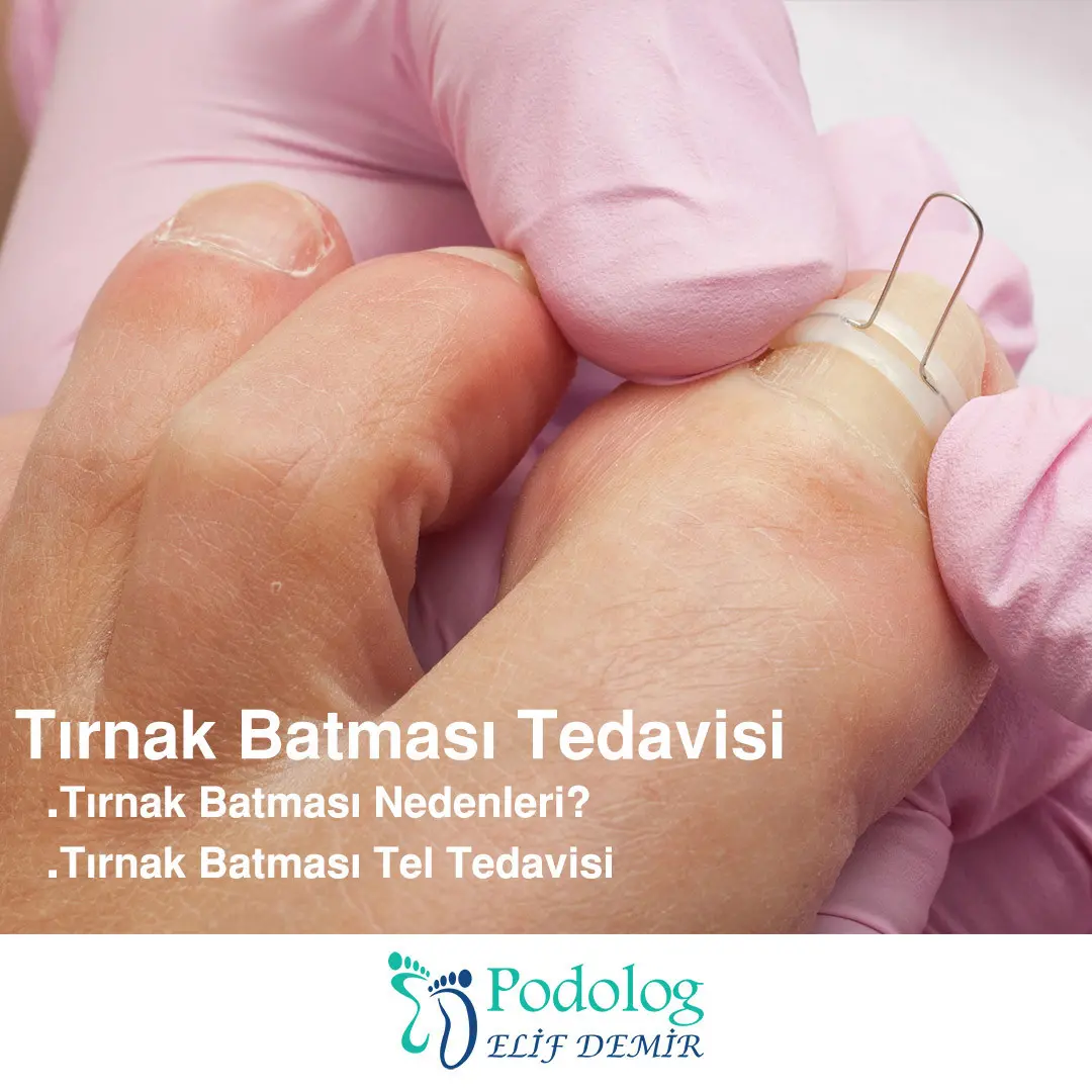 tirnak-batmasi-tedavisi.jpg