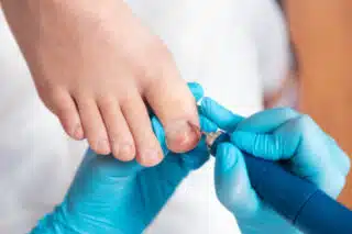Tırnak Batması Tedavisi